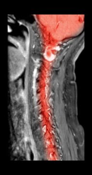 Magnetic resonance imaging sagittal scan of the cervical and thoracic spine with the spinal cord highlighted in red on grayscale background.