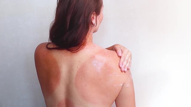 Caucasion woman with red skin burnt in the sun on her back. Swimsuit skin marks. Woman touches red sunburned back. Skin irritation from sun exposure needs care. footage