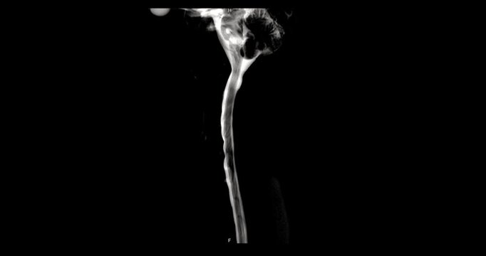 Grayscale MR myelography maximum intensity projection showing cerebrospinal fluid and spinal canal of the human spine on black background.