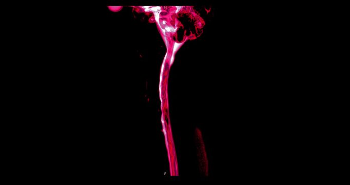 Colorized red and pink MR myelography maximum intensity projection of the human cervical spine and spinal canal on black background.