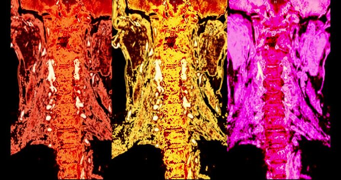 Multicolor red yellow and magenta MRI coronal scan of the human cervical spine and neck rotating on black background.