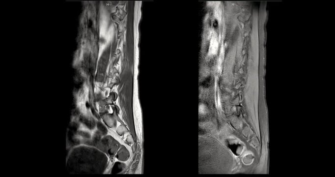 Grayscale T1 weighted and gadolinium contrast enhanced MRI sagittal scan of the human lumbar spine on black background.