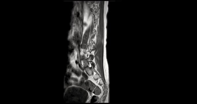 Grayscale T1 weighted magnetic resonance imaging sagittal scan of the human lumbar spine and lower back on black background.