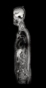 Grayscale contrast enhanced MRI screening scan of the whole human spine from head to pelvis on black background vertical animation.
