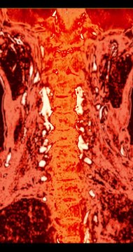 Colorized red and orange MRI coronal maximum intensity projection of the human cervical spine and neck rotating on black background vertical medical animation.