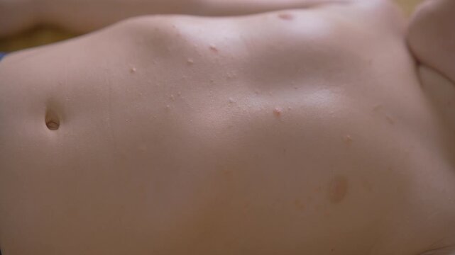 Child chest covered with red spots and small blisters. Close-up.