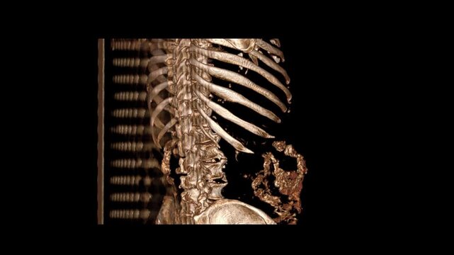 Focus on NCCT KUB 3D Volume Rendering of Spine and Lower Ribs