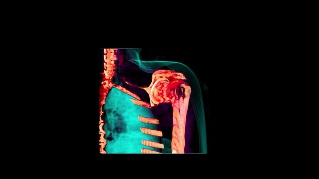 Focus on Color-Rendered 3D CT Right Shoulder Joint and Chest Cavity