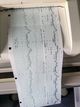 Cardiotocograph paper plotting fetal heart rate and