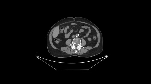 Non-Contrast CT Abdomen and Pelvis Axial 1.25 mm DICOM Medical Imaging Anatomy Loop
