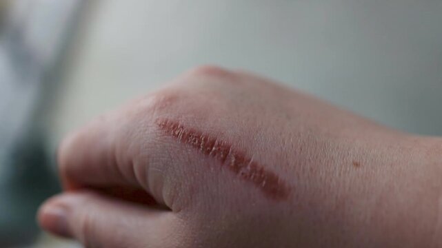 detailed close-up shot of a human hand showing a fresh painful burn wound, red damaged skin, and blisters after a thermal accident, focusing on dermatology, first aid, and skin trauma recovery.