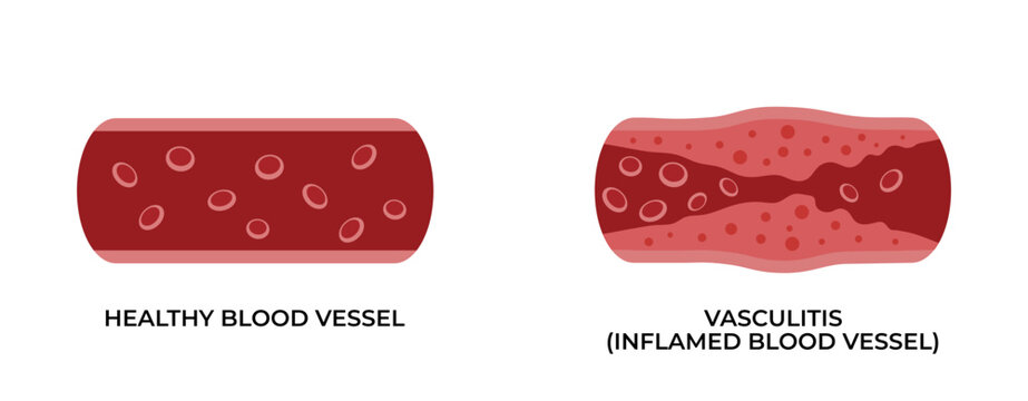Vein diseases of vasculitis with blood viscosity, vector medical infographic icons. Vein diseases of vascular artery and reduced blood flow.