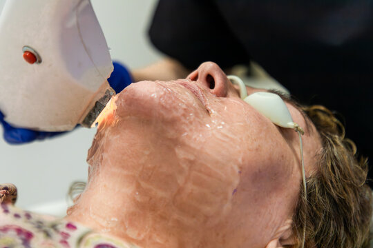 Senior woman receiving laser facial skin treatment