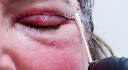 Fototapeta premium Close-up of a patient having sutures removed after facial and neck surgery during a postoperative follow-up appointment. Medical professional swabbing or removing stitches near the ear.