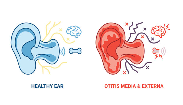 Medical comparison diagram showing a blue healthy ear alongside a red inflamed ear affected by otitis media and externa.