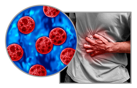 Cyclosporiasis disease as a foodborne parasitic illness caused by Cyclospora cayetanensis as an outbreak with contaminated food or water resulting in explosive diarrhea and digestive illness.