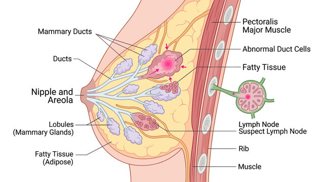 Human Breast Anatomy Diagram: Mammary Ducts, Lobules, and Cancerous Cell Cluster