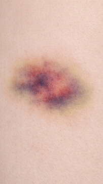 The image shows the healing process of a skin injury, with visible redness, inflammation, and scab formation as the body attempts to repair itself.