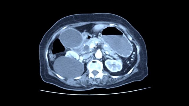 CT scan abdomen x-ray image and MRI abdominal scan show liver, colon,spleen, small intestine, bladder. radiologic and radiology.