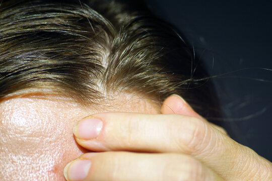 Woman examining her forehead with her fingers, naturally oily skin texture and visible pores in close-up. Represents sebum-prone T-zone assessment, facial oil control, and skincare routine planning.