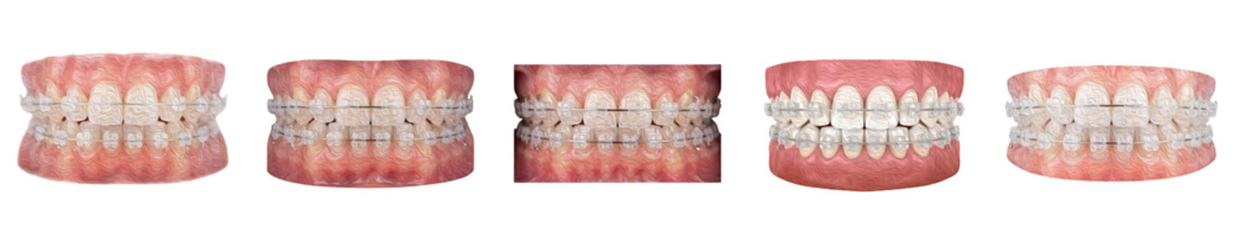 set of the five isolated Haman  ceramic braces on withe background PNG photo ''