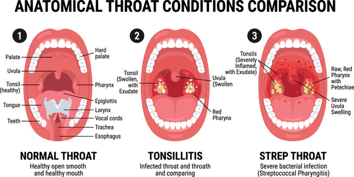 Anatomical Throat Conditions Comparison Vector Infographic Illustrating Normal Healthy Mouth Tonsillitis Infection and Bacterial Strep Throat Diagnoses