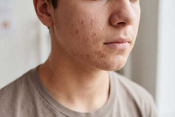 Fototapeta premium Young person's face showing acne and skin problems