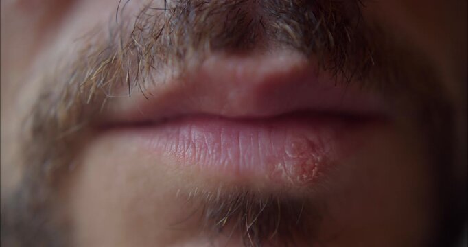 Close-up of a man's lips with a cold sore: This extreme close-up focuses on a man's mouth, revealing the texture of his lips and the presence of a cold sore, a common viral infection.