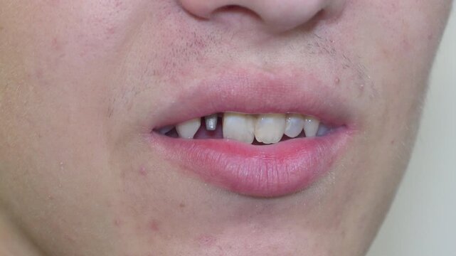 Man showing dental pin in damaged front tooth, Close up of a tooth prepared for dental crown restoration