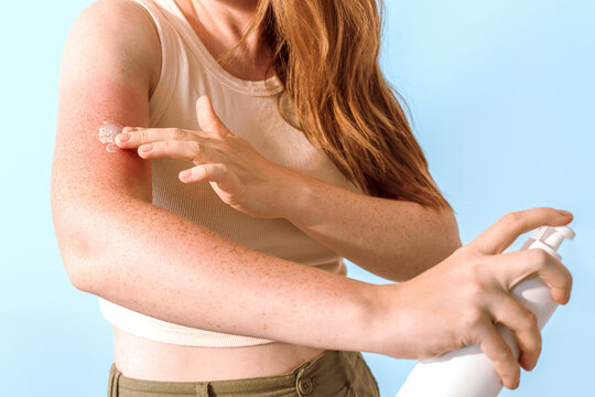 Treating Sunburn With Protective SPF Moisturizing Skincare Lotion Or Cream
