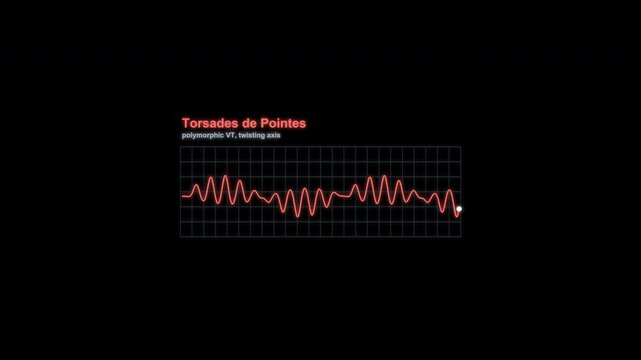 Torsades de Pointes ECG Rhythm Animation Labeled Heart Monitor Alpha 4K