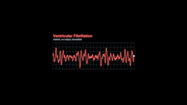 Ventricular Fibrillation ECG Rhythm Animation Labeled Heart Monitor Alpha 4K