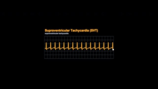 Supraventricular Tachycardia (SVT) ECG Rhythm Animation Labeled Monitor Alpha 4K