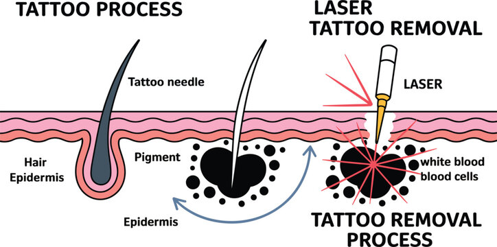Tattoo Process and Laser Tattoo Removal Diagram Showing Skin Pigment, Tattoo Needle, Laser Treatment, and White Blood Cell Response