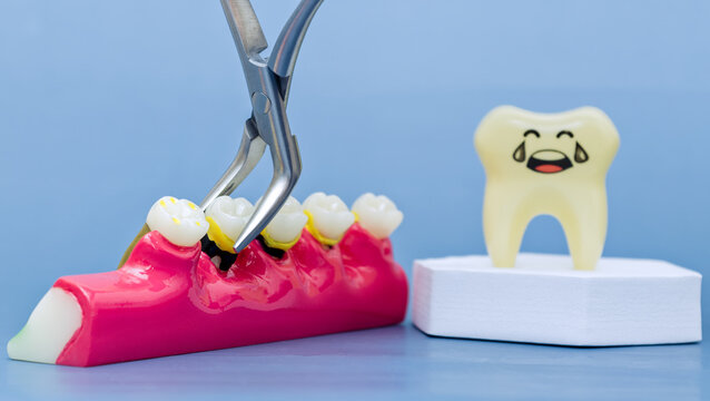 Dental forceps extracting a decayed tooth from a jaw model. Concept of dental surgery, toothache, and fear of dentist with sad crying cartoon tooth.