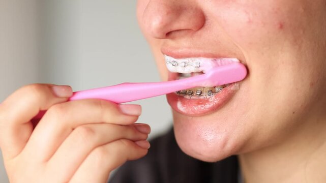 Slow motion video young woman brushes teeth with braces in close up. Pink toothbrush and foamy toothpaste show careful dental hygiene. Proper oral care supports healthy smile.