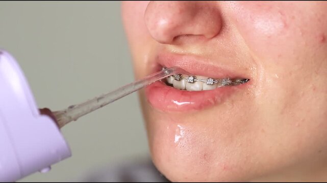 Slow motion close up video shows young woman with braces cleaning teeth using water flosser. Food washes from braces with splashes and flowing water. Proper oral hygiene routine.