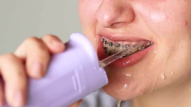 Slow motion close up video shows young woman with braces cleaning teeth using water flosser. Food washes from braces with splashes and flowing water. Proper oral hygiene routine.