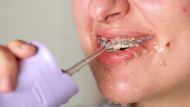 Slow motion close up video shows young woman with braces cleaning teeth using water flosser. Food washes from braces with splashes and flowing water. Proper oral hygiene routine.