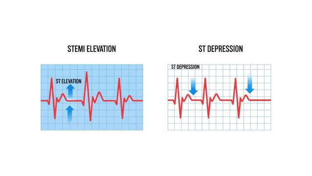 Medical ECG Comparison of STEMI Elevation and ST Depression on Grid Background. Ideal for cardiology education and healthcare presentations.