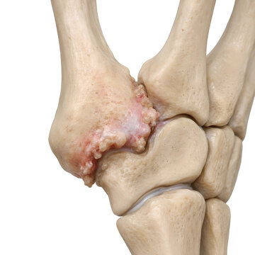 Thumb Base Arthritis With Osteophytes in Photorealistic 3D Anatomy Render, Isolated Carpometacarpal Joint Medical Illustration for Healthcare, Orthopedic Education, Radiology, and Patient Awareness
