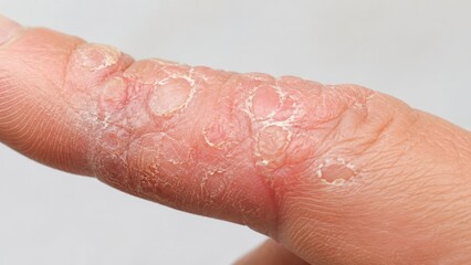 Fototapeta premium Close-up of hand finger skin with severe dryness cracking and flaky texture showing irritation and damage