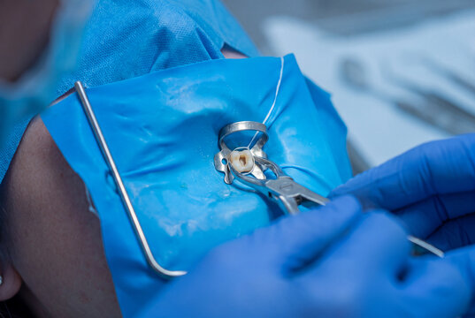 Close up view of a patient mouth with a blue rubber dam isolator and metal clamp during a precise root canal endodontic surgery procedure in a dental clinic.