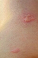 Fototapeta premium Close up of a severe skin rash and hives on a person's stomach due to an acute allergic reaction