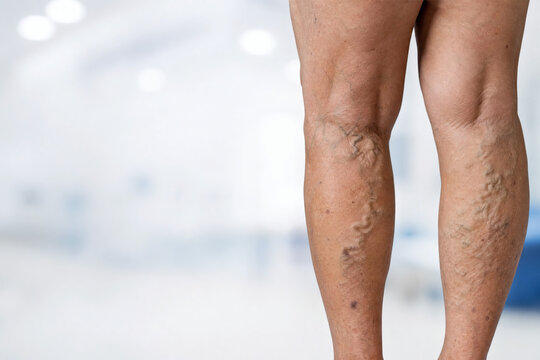Bilateral Varicose Veins of the Lower Legs in an Older Adult