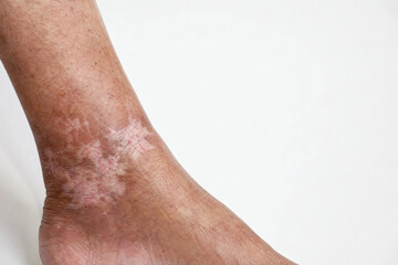 Fototapeta premium Atrophie Blanche on Elderly Asian Woman's Ankle — White Atrophy Skin Condition