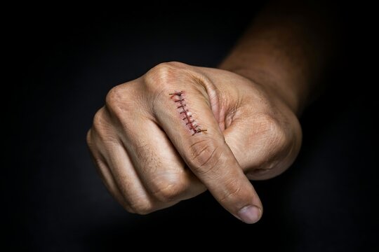 Close up of a human finger with a stitched surgical wound on a dark black background