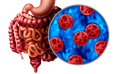 Cyclosporiasis as a foodborne parasitic infection caused by Cyclospora cayetanensis spreading through contaminated food or water as an outbreak of parasitic infections explosive watery diarrhea severe