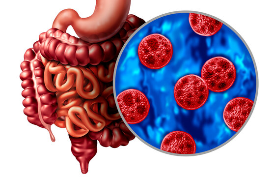 Cyclosporiasis as a foodborne parasitic infection caused by Cyclospora cayetanensis spreading through contaminated food or water as an outbreak of parasitic infections explosive watery diarrhea severe