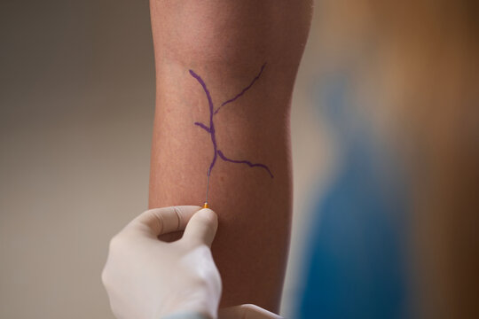 Phlebology Sclerotherapy Injection. Phlebologist injects medication into varicose veins on female leg. Surgeon performs sclerotherapy procedure on lower limb